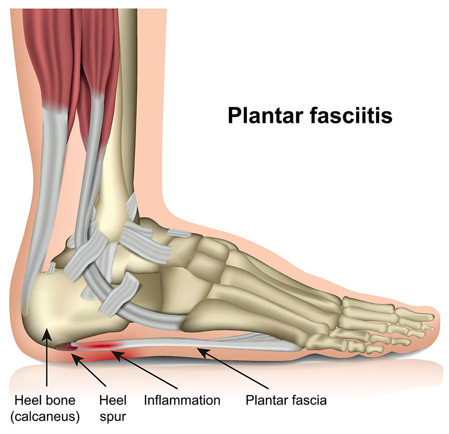 Plantar Fasciitis Treatment Symptoms And Causes Healthdirect
