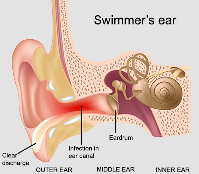 medical illustration of swimmer's ear